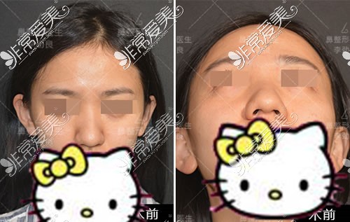 盘点北京隆鼻好医院日记，做鼻部整形这几家更有特点！