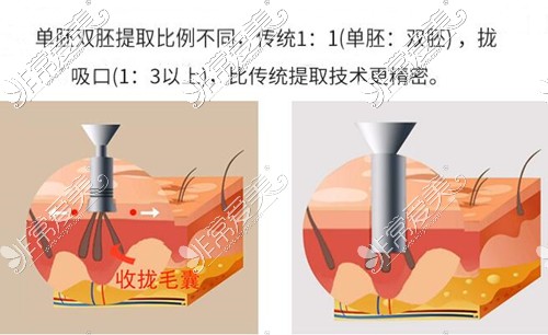 新生3D植发拢吸口提取毛囊图