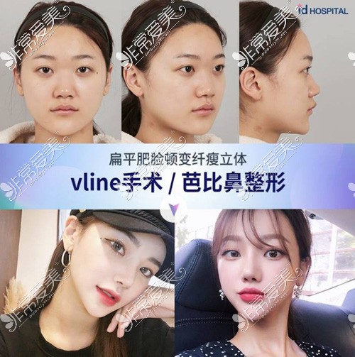 韩国ID医院Vline手术案例