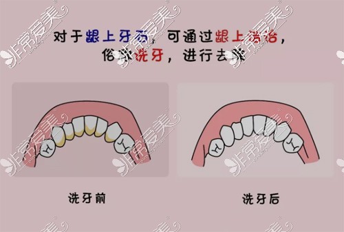 不要随便做龈下刮治？为什么牙齿刮治做了后悔死了！