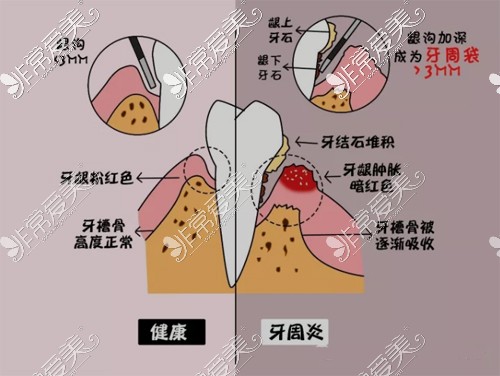 健康牙龈和牙周炎对比