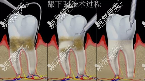 牙龈刮治动画图