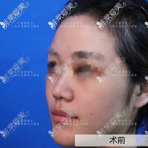 上海华美叶丽萍隆鼻怎么样