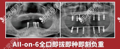 上海全口种植改善参考照片