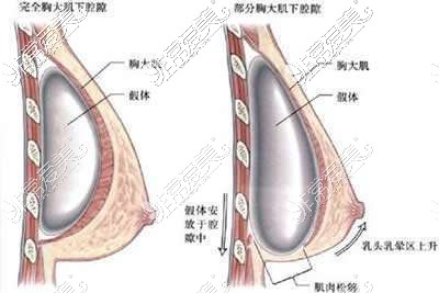 北京整形医院隆胸价格全公开，这份丰胸价目表超全！