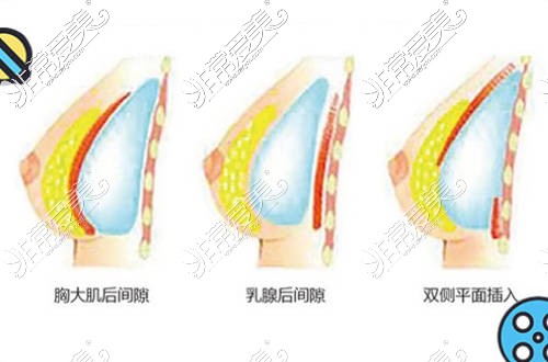 深圳假体隆胸口碑好的医生盘点，正规隆胸医院价格是多少