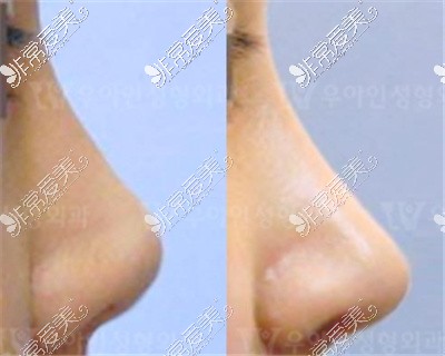 韩国优雅人整形外科隆鼻案例
