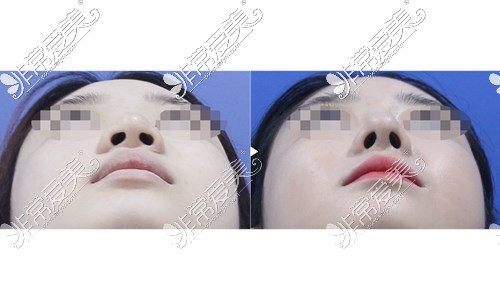 韩国可来熙鼻头鼻翼缩小术,这几种类型的鼻子都可以单独做!