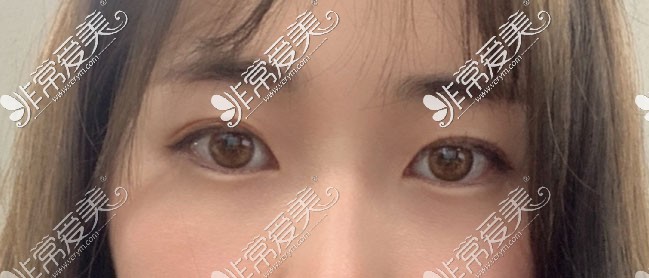 韩国yellow整形医院双眼皮手术照片