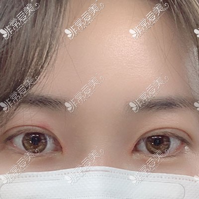 韩国双眼皮手术恢复案例