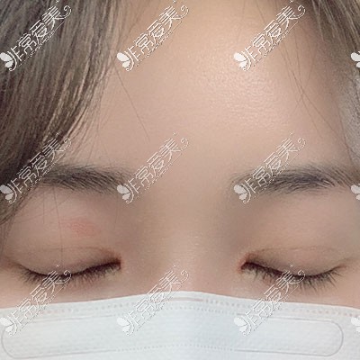 韩国双眼皮手术闭眼无疤痕图片