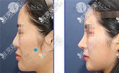 韩国nano整形外科隆鼻风格