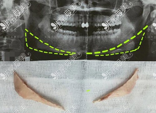 下颌角整形CT示意图