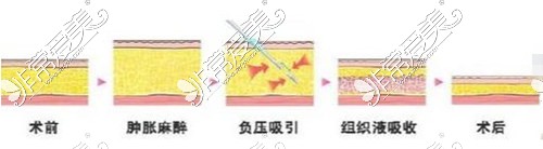 吸脂示意图