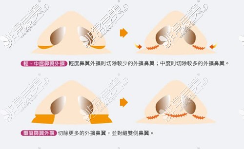 缩鼻翼示意图