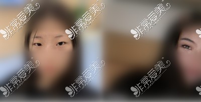 重庆联合丽格美容医院双眼皮<span style=