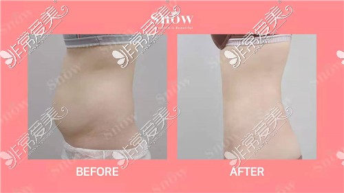 韩国SNOW整形外科腰腹吸脂图