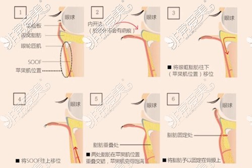 济南韩氏眶隔脂肪释放