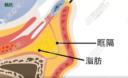 济南韩氏不去脂肪去眼袋