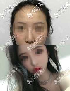 昆明美立方亚明宏医生肋软骨隆鼻<span style=