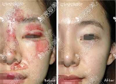 韩国去疤痕医院排行揭晓!韩国治疗疤痕比中国厉害吗？