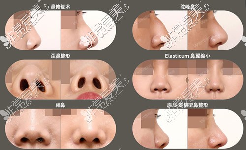 韩国原辰整形隆鼻案例展示
