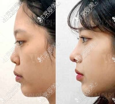 韩国优雅人整形外科隆鼻真人案例对比
