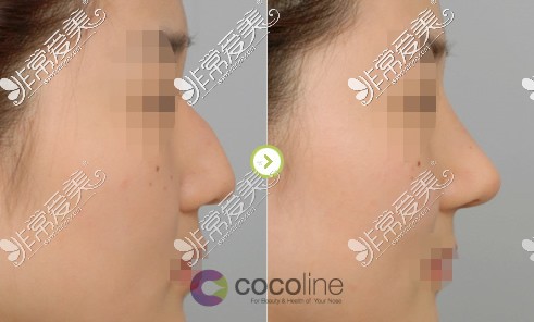 韩国cocoline整形外科隆鼻案例