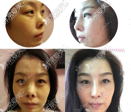 韩国4月31日整形外科隆鼻真人效果图