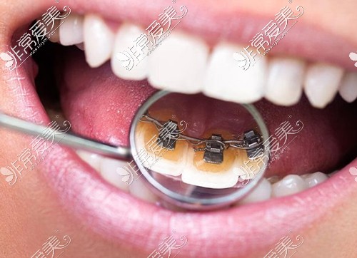 舌侧金属托槽矫正器