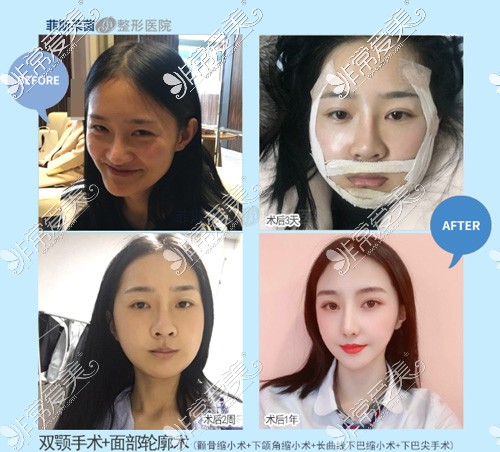 韩国菲斯莱茵Faceline整形外科双鄂手术案例