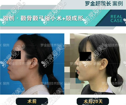 罗金超磨骨怎么样 罗金超磨骨怎么样