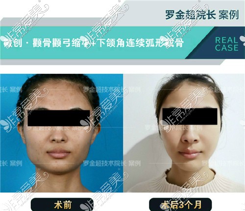 罗金超磨骨效果对比图 罗金超磨骨效果对比图