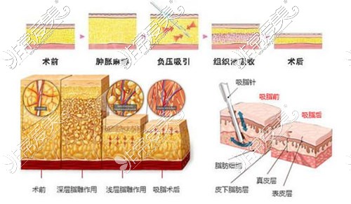 吸脂手術(shù)原理