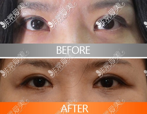 韩国修复双眼皮厉害的医生名单,都是韩国做眼睛出名的医生!