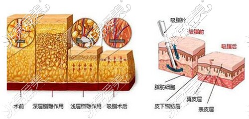 吸脂卡通照片