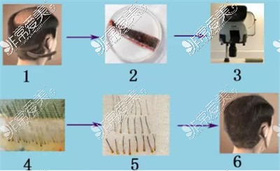 毛发种植流程