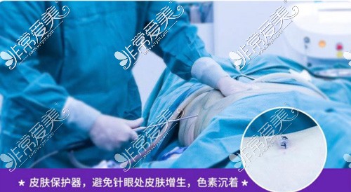 东莞大腿抽脂去哪里做好?大腿环吸需要多少钱?