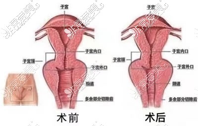 竹一医疗美容医院缩阴图