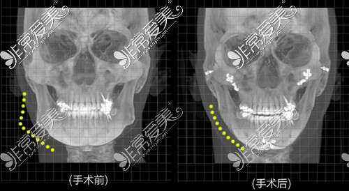 韩国原辰整形外科医院面部轮廓案例