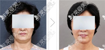 韩国面部提拉手术费用多少?当地人做面部提升都去哪些医院?