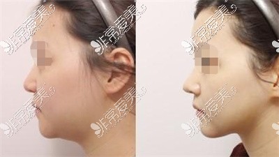 韩国面部提拉手术费用多少?当地人做面部提升都去哪些医院?