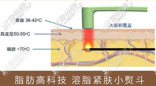 深圳福雅整形醫(yī)院吸脂原理