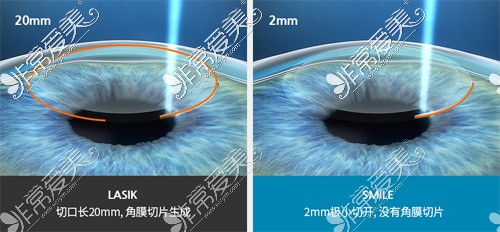 韩国KEYE恺熠眼科手术方式对比