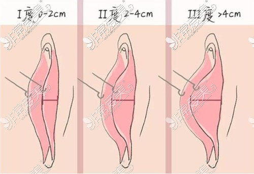 私密整形