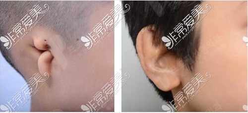 韩国普罗菲耳整形外科耳畸形案例
