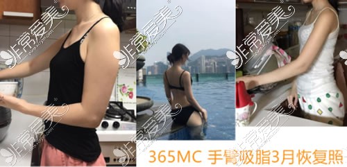 韩国365MC医院手臂吸脂特点分析