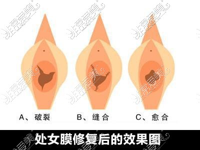 处修手术值得做吗?听说成功率很低是不是白花钱了?