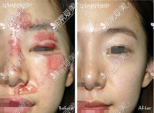 韩国Dr.hams整形医院烧伤疤痕修复