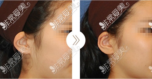 8种耳廓畸形图片分享，揭秘耳廓畸形矫正费用多少！